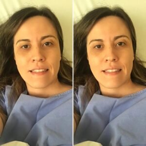 Foto antes e depois da cirurgia